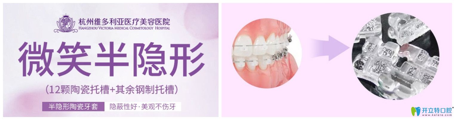 杭州維多利亞半隱形陶瓷托槽矯正