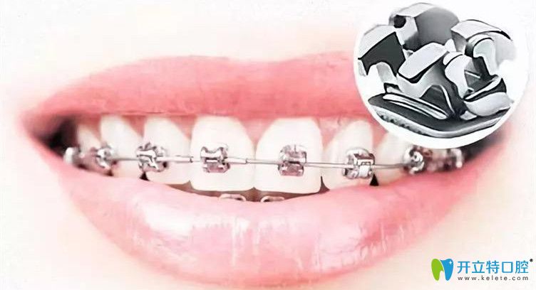 牙齒矯正過程中需要注意的地方