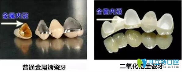 全瓷冠與烤瓷冠區(qū)別