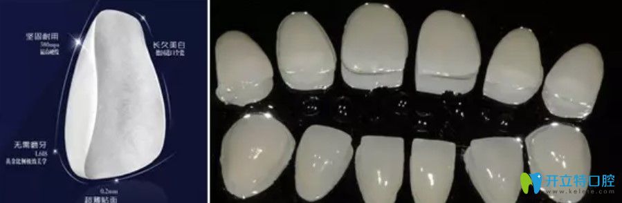 牙齒貼面的材料有哪些