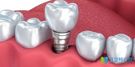 咸陽(yáng)海濤口腔種植牙技術(shù)