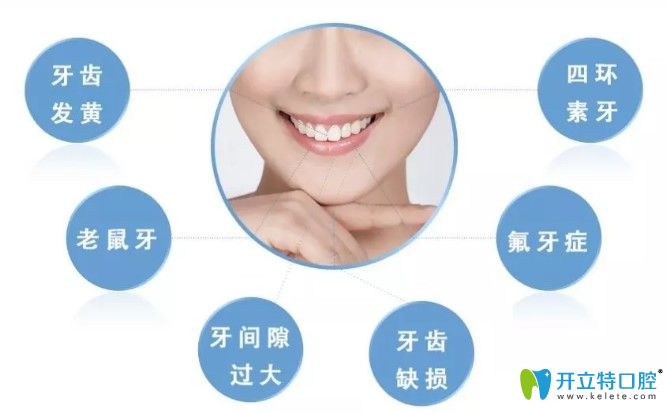 哪些牙齒情況可以做牙齒貼面