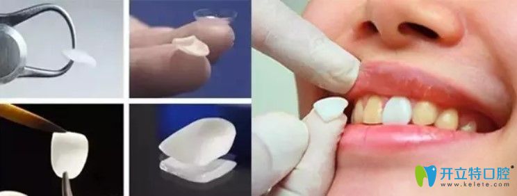 洪超醫(yī)生告訴你什么是牙齒貼面