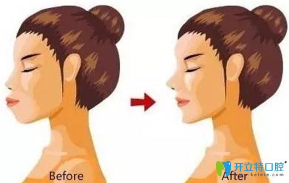 牙齒矯正對(duì)側(cè)面臉型影響比較大