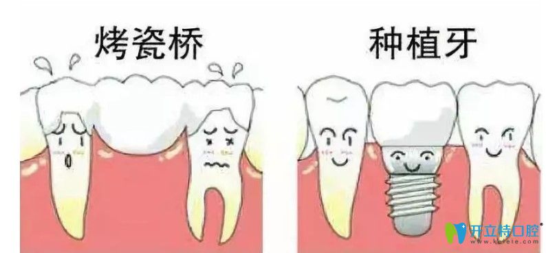 李勝剛解析牙齒缺失選擇種植牙好還是烤瓷牙好 李勝剛解析牙齒缺失選擇種植牙好還是烤瓷牙好