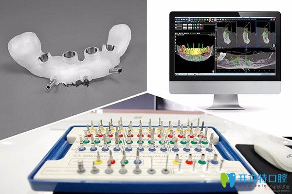 3D導(dǎo)板種植牙 3D導(dǎo)板種植牙