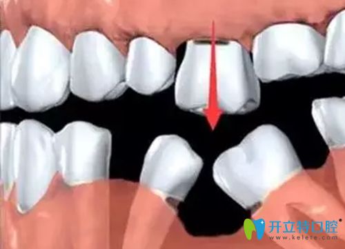 缺一顆牙后會引起臨牙脫落