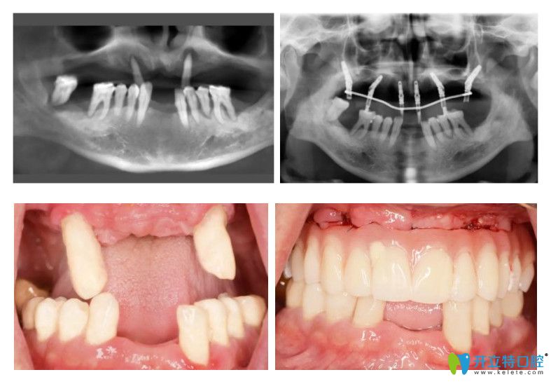 種植半口牙的病例