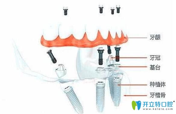 瑞典諾貝爾allon4種植技術(shù)