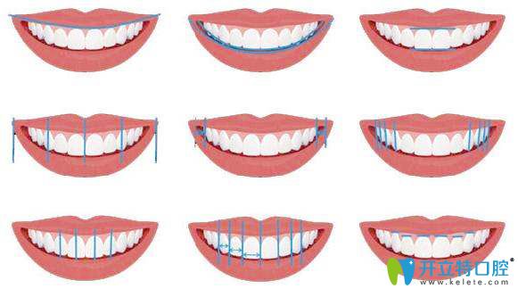 泉州美萊口腔美學(xué)正畸微笑弧線設(shè)計 泉州美萊口腔美學(xué)正畸微笑弧線設(shè)計
