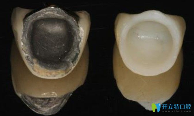 祁凱醫(yī)生解析全瓷牙和烤瓷牙哪個好