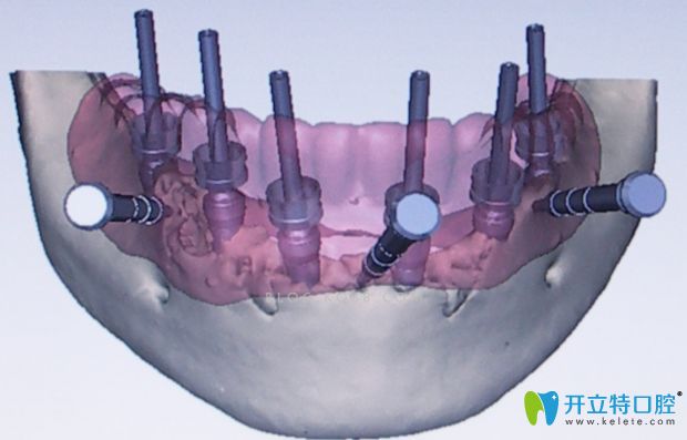 3D導(dǎo)板種植技術(shù)圖