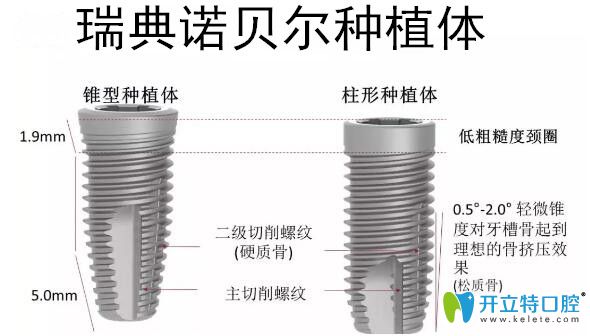 瑞典諾貝爾種植體優(yōu)勢(shì)