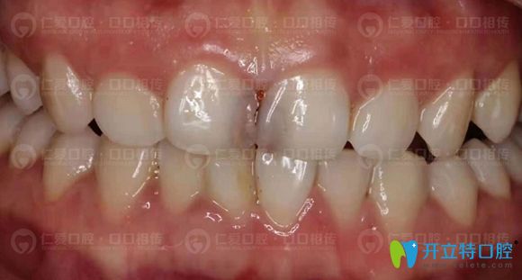 樹脂補(bǔ)牙多少錢?這有武漢仁愛口腔前牙美學(xué)修復(fù)價格及效果