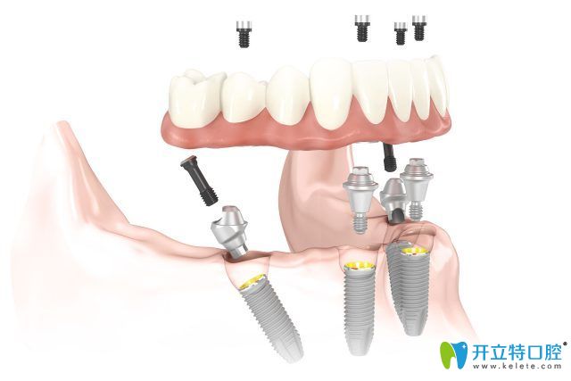 瑞士blt種植體是什么材質(zhì)？細(xì)數(shù)iti blt種植體優(yōu)缺點有哪些？