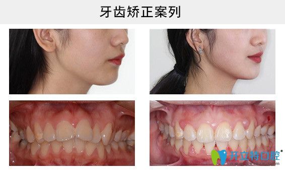 牙列擁擠矯正前后圖片
