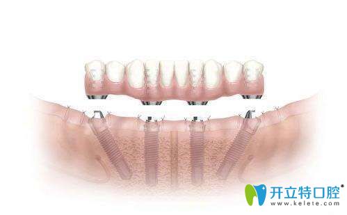 半口種植牙介紹圖 半口種植牙介紹圖