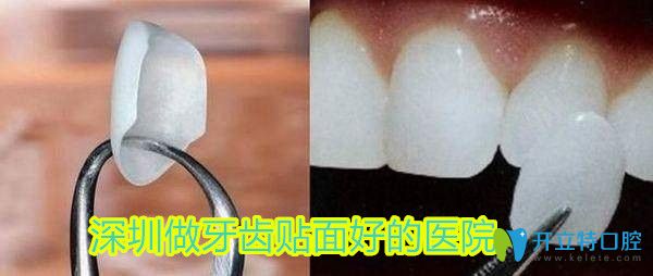 深圳做牙齒貼面哪家好