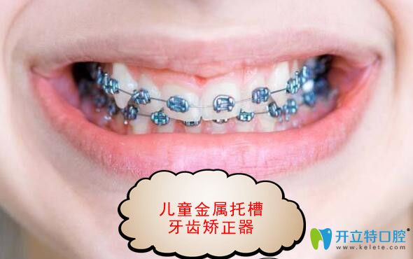 兒童金屬托槽牙齒矯正器