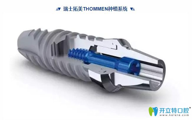 瑞士拓美（thommen）種植體價格