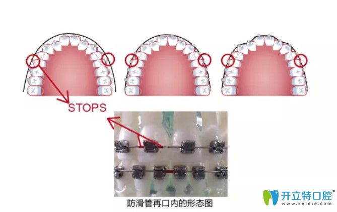 分享國產普特自鎖托槽價格是多少?普特3代和5代托槽怎么選