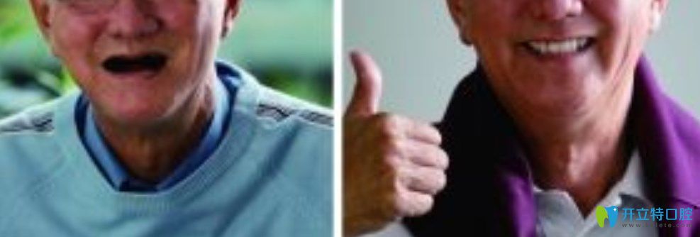 70張大爺在東營鉑爾口腔做ALL-ON-4全口種植牙當天就能吃東西