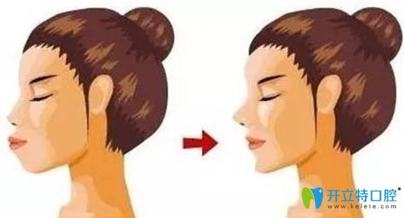 戴牙套嘴巴會變凸?武漢仁愛口腔隱形牙套矯正案例來澄清