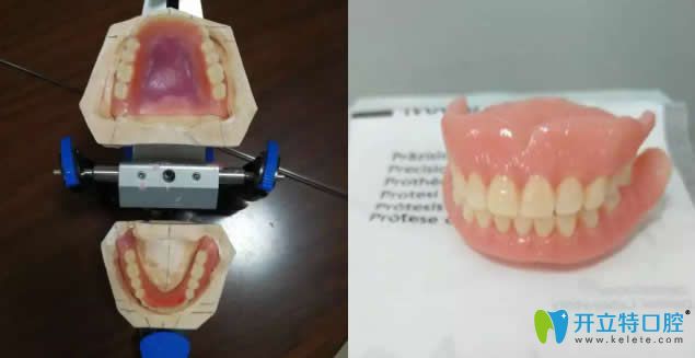 東營(yíng)鉑爾口腔制作好的吸附性義齒