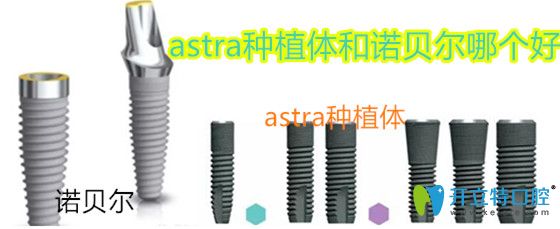 astra種植體和諾貝爾哪個好