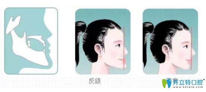 牙齒地包天的危害有哪些