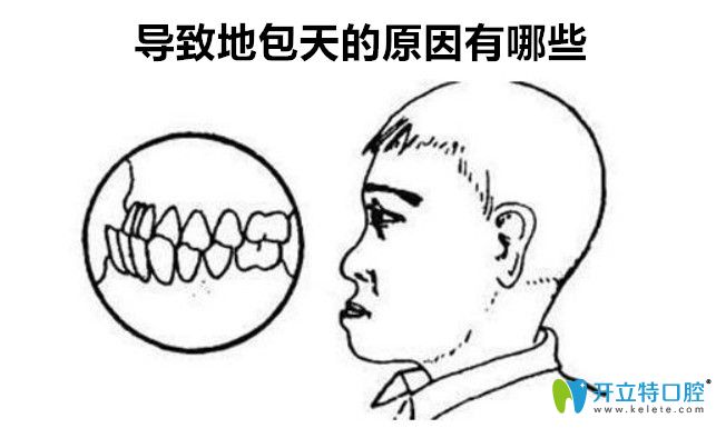 導致地包天的原因有哪些