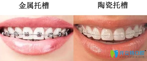 金屬托槽和陶瓷托槽矯正效果對比圖