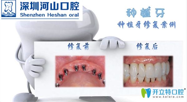 搞到了深圳世紀(jì)河山口腔全口/多顆種植牙成功案例對(duì)比圖片