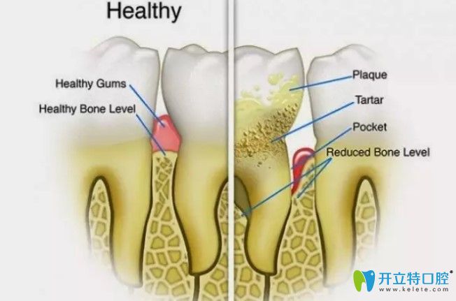 樸月梅醫(yī)生告訴大家牙周治療后的注意事項
