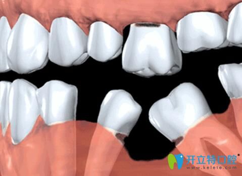 缺牙不補(bǔ)的危害