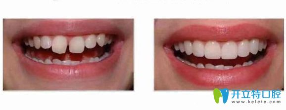 牙縫大做完牙齒矯正前后對比圖 牙縫大做完牙齒矯正前后對比圖
