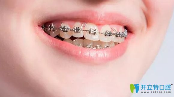 壹加壹口腔金屬托槽牙齒矯正特色