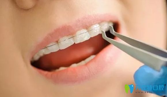 壹加壹口腔陶瓷托槽矯正效果圖
