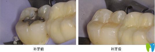 補牙前后對比圖