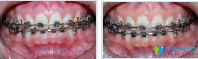 深覆合矯正 深覆合矯正