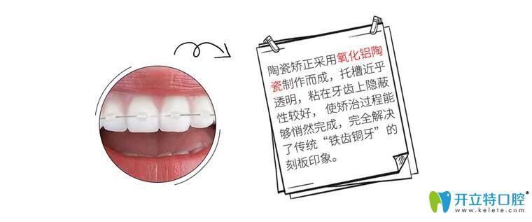 半隱形矯正簡介