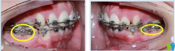 金屬托槽矯正案例 惠州致美口腔 金屬托槽矯正案例 惠州致美口腔