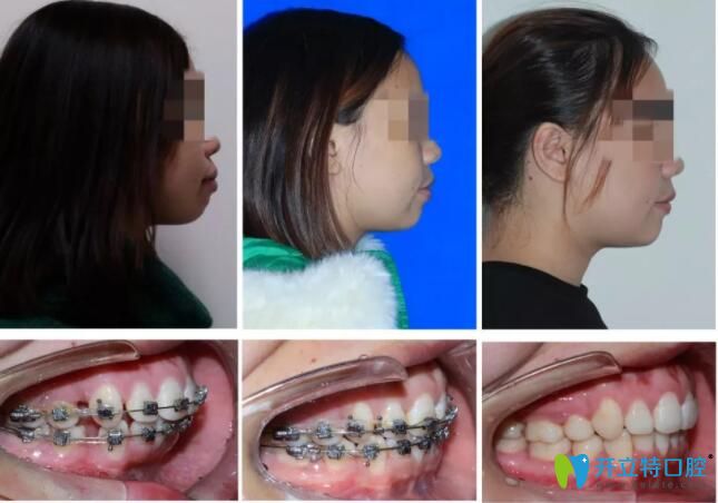 惠州致美口腔牙齒矯正前后對(duì)比 惠州致美口腔牙齒矯正前后對(duì)比