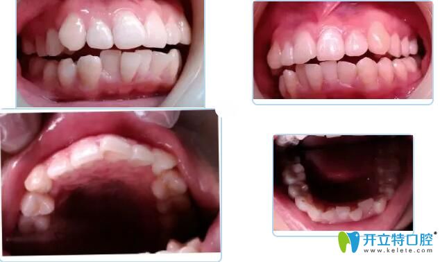 惠州致美口腔金屬矯正案例 惠州致美口腔金屬矯正案例