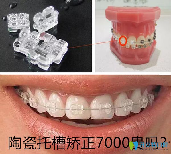 陶瓷托槽矯正7000元貴嗎?與15000自鎖托槽的優(yōu)缺點和區(qū)別是啥