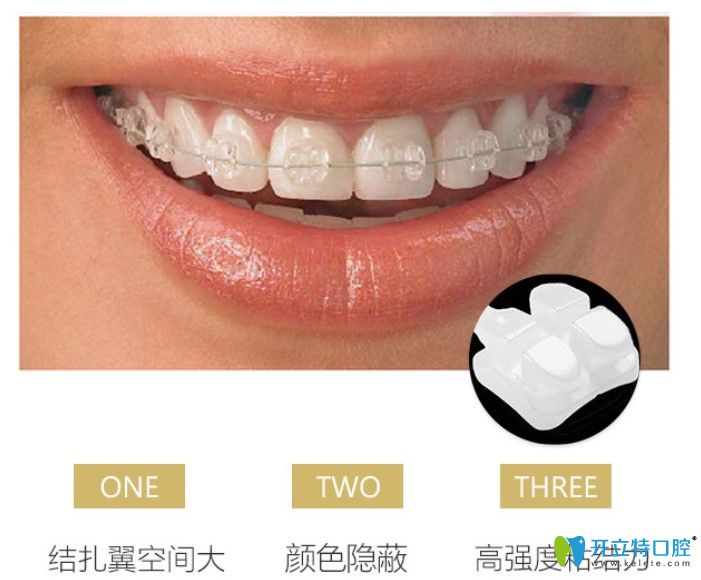 廣州壹加壹口腔陶瓷半隱形牙齒矯正價(jià)格