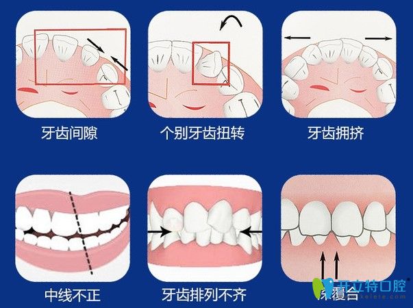 廣州壹加壹口腔告訴你佩戴隱形牙套的注意事項(xiàng)