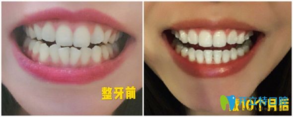 時代天使隱形矯正10個月前后效果圖