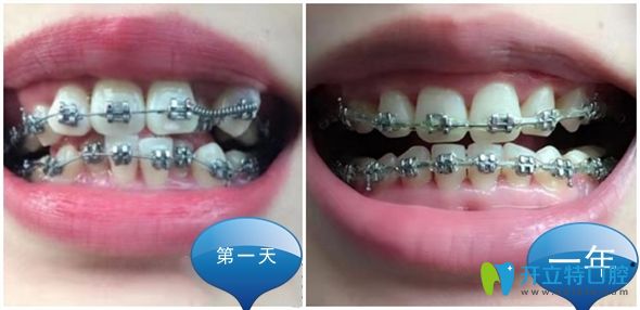 金屬自鎖托槽矯正1年前后效果圖