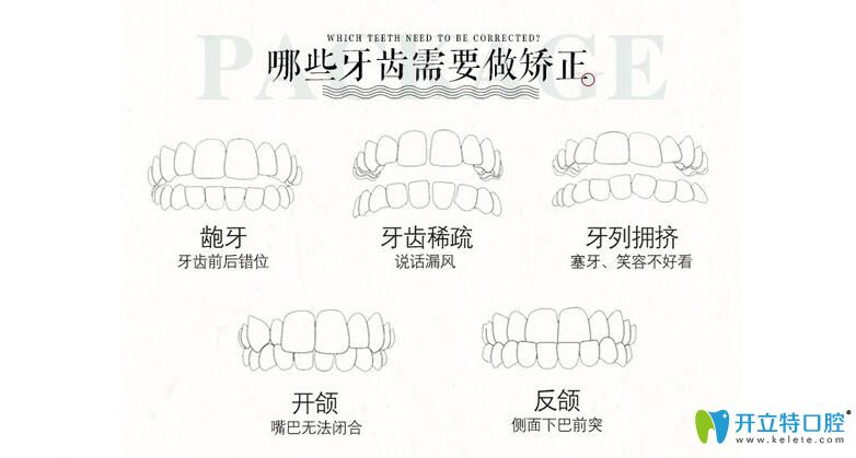 需要做牙齒矯正幾種情況